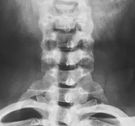 Premier Radiology Cervical rib xray example