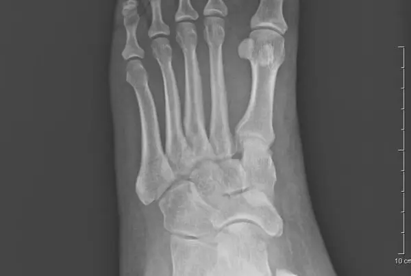 premier radiology lisfranc fracture dislocation x-ray of foot