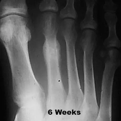 Premier Radiology image of stress fracture X-ray 6 weeks