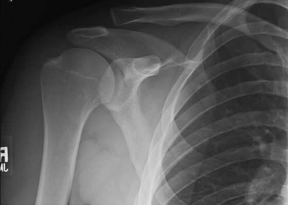Premier Radiology AC Joint Separation Image