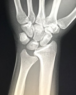 Premier Radiology image of Madelung Deformity Of Wrist X-ray