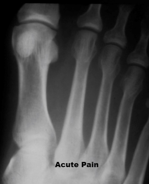 Premier Radiology image of stress fracture X-ray with acute pain